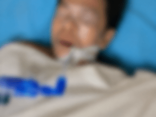 Korban Kecelakaan Kerja di Area PT. Vale Masih Jalani Perawatan, Alami Luka di Lengan dan Badan